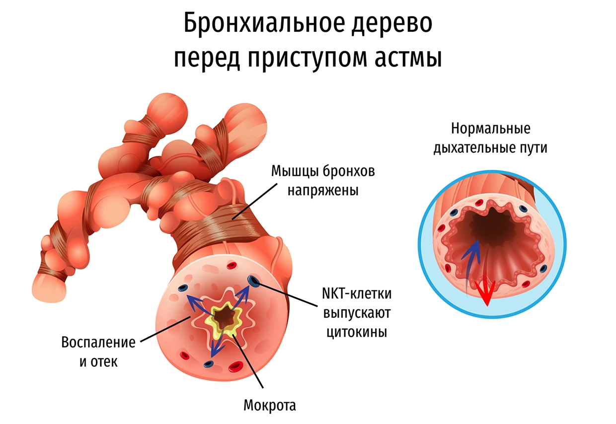 Бронхиальная астма у детей - симптомы, причины, методы диагностики и лечения